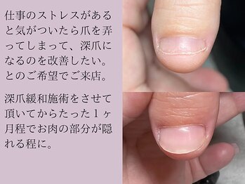 サロンエヌ(salon enu)/パラジェル深爪緩和クリアコース