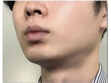 クラフト フェリーチェ 横芝店(CRAFT×felice)/ひげ脱毛、20代男性8回目