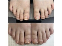 リリ(lili)/フットネイルスキンケア3回目