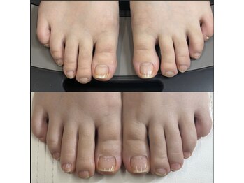 リリ(lili)/フットネイルスキンケア3回目