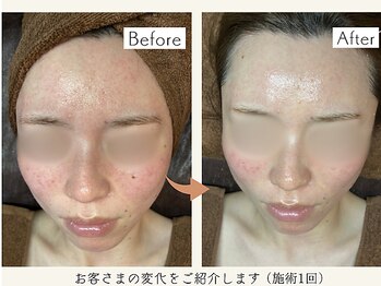 ベリル(BERYL)/赤み悩み/施術1回before after