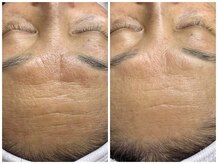 ウパラギンザ(Upala Ginza)/光フェイシャルでシワ改善♪