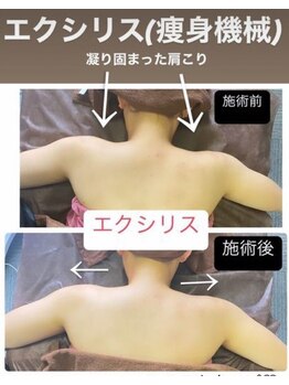 リベル(Liber)/肩こりにもエクシリス