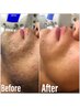 【男性】ヒゲ脱毛体験◆初回¥3000《脱髭剃り！脱毛デビューに◎》回数：1回