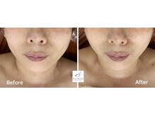 ソワベル(Soi Belle)の雰囲気（小顔フェイシャル（50代のお客様）フェイスライン、食いしばり）