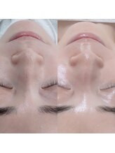 アミーサロン(amy salon)/　【カーボキシー炭酸パック】