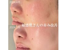 てづか整骨院 西都院/潤う艶肌フェイシャル