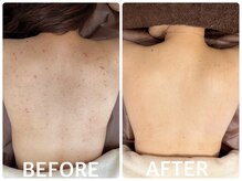 ハーブピーリング横浜の雰囲気（ターンオーバーを整える2bbiobeautyは長年のニキビケアに◎）