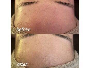 リノ(Lino)/プラズマbefore after