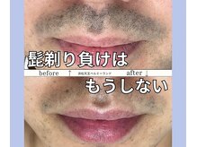 ベルミーランド 浜松天王/脱毛Before→After