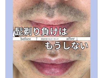 ベルミーランド 浜松天王/脱毛Before→After