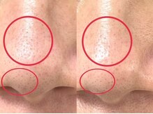 シェリー(Cheri)/いちご鼻毛穴洗浄吸引