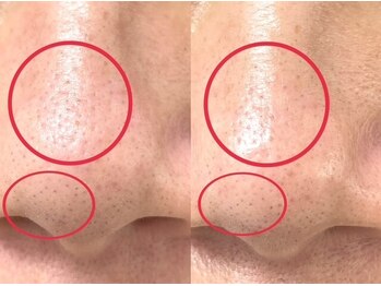 シェリー(Cheri)/いちご鼻毛穴洗浄吸引