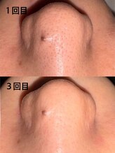 プローズアミカクラブ 高槻店/毛穴吸引