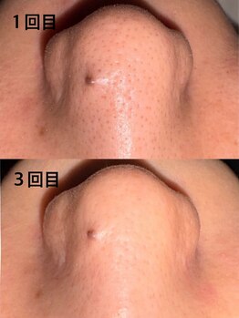 プローズアミカクラブ 高槻店/毛穴吸引