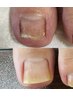 【まずは相談】足の爪のトラブルカウンセリングのみ