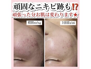 アルムダアクア 天王寺店(Aleumda AQUA)/ハーブピーリング/大阪/天王寺