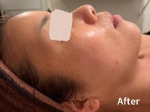 ダイヤモンド リーエンダ(Diamond leende)/クレイハーブピーリング