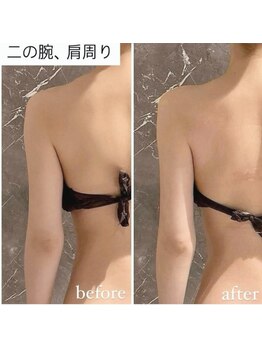 インディバ 六本木/【二腕シェイプ】before→after