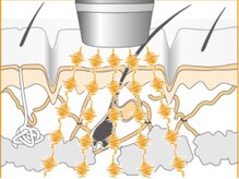 サロン スピカ/エレクトロポレーションとは
