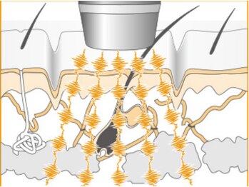 サロン スピカ/エレクトロポレーションとは