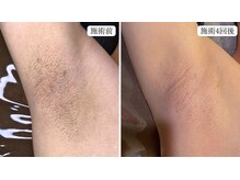 トパーズ 藤枝店(Topaz)/脇脱毛　清潔感UP ニオイ軽減