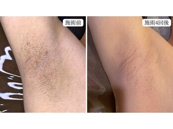 トパーズ 藤枝店(Topaz)/脇脱毛 清潔感UP ニオイ軽減