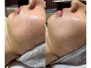 マザートウキョウ(Mother TOKYO)/色素ケアお任せください!4回