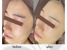 アン ビューティー(ann beauty)/リピーター様 20代前半