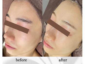 アン ビューティー(ann beauty)/リピーター様 20代前半