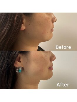 デディア 恵比寿(dedia)/レモンボトルで速攻小顔