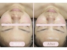 エピル(EPIL)/ララピール＋毛穴洗浄症例