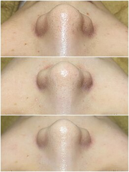 ミーラヤ(MILAYA)/梅田毛穴/梅田リアボーテ