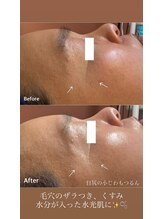 リノ(lino)/水光肌コース