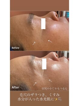 リノ(lino)/水光肌コース