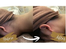 チャンティック(Cantik)/ブライダル脱毛