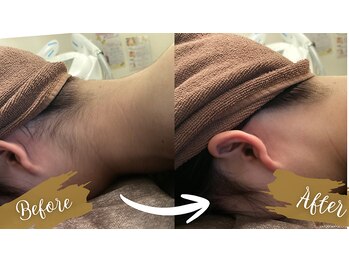 チャンティック(Cantik)/ブライダル脱毛