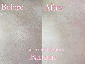ラナン(Ranun)/背中シュガーリング脱毛の変化