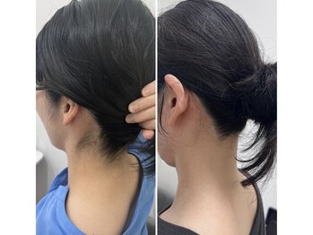 ミース 池袋店/うなじ矯正◆ビフォーアフター