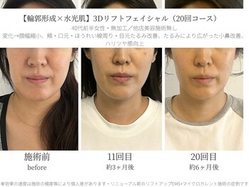 サボラミ(sabor A Mi)/この施術だけ！！20回券¥220,000