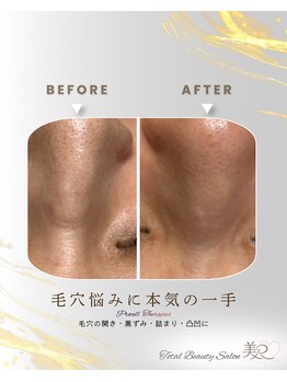 美Rの写真/シミ・毛穴・お肌の凸凹などなど♪お一人おひとりのお悩みに合わせたフェイシャルメニューで理想のお肌へ◎