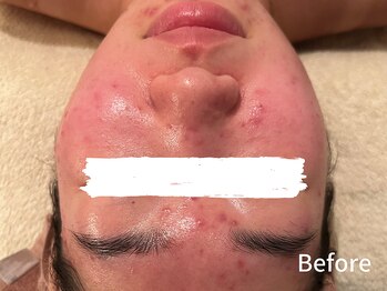 ダイヤモンド リーエンダ(Diamond leende)/クレイハーブピーリング