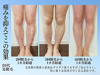 アンジェリーナ/メンズフラッシュ脱毛/足脱毛