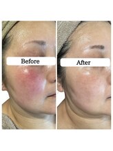 ル ボヌール 伊那店(le bonheur)/シミケアで肌質改善