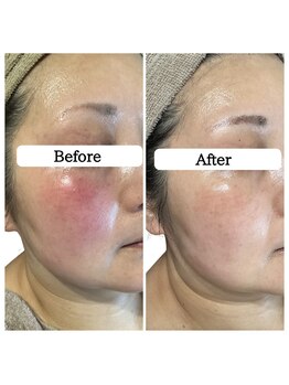 ル ボヌール 伊那店(le bonheur)/シミケアで肌質改善