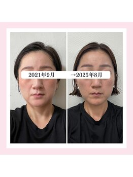 ル フラーズ(Les Fleurs)/小顔矯正歴6年