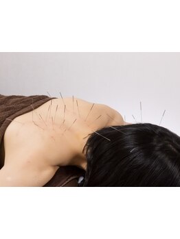 鍼灸施術を受けたい