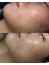 ココリール/ニキビ・赤み