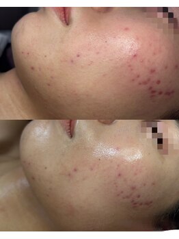 ココリール/ニキビ・赤み