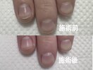 たった1回でこの変化！自爪育成